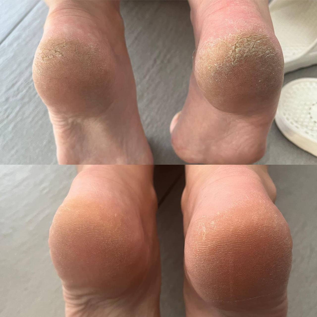 Crème pour les pieds à l'huile de Neem - 75 ml